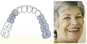 Treatment of partly edentulous jaws
