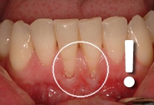 Izpostavljeni zobni vratovi