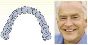 Treatment of edentulous jaws