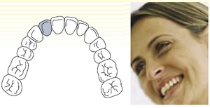 Single tooth restoration