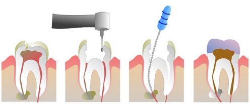 Akutni zobobol