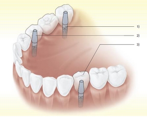 Implant structure