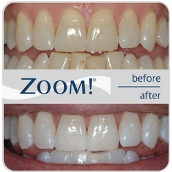 Teeth whitening ZOOM! before and after