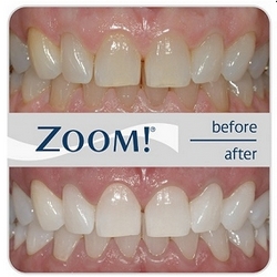 Effective Zoom! whitening system